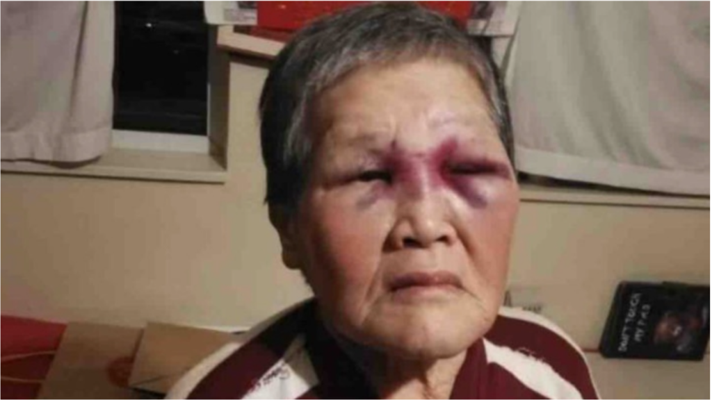 an image of an elderly asian woman with a bruised eye