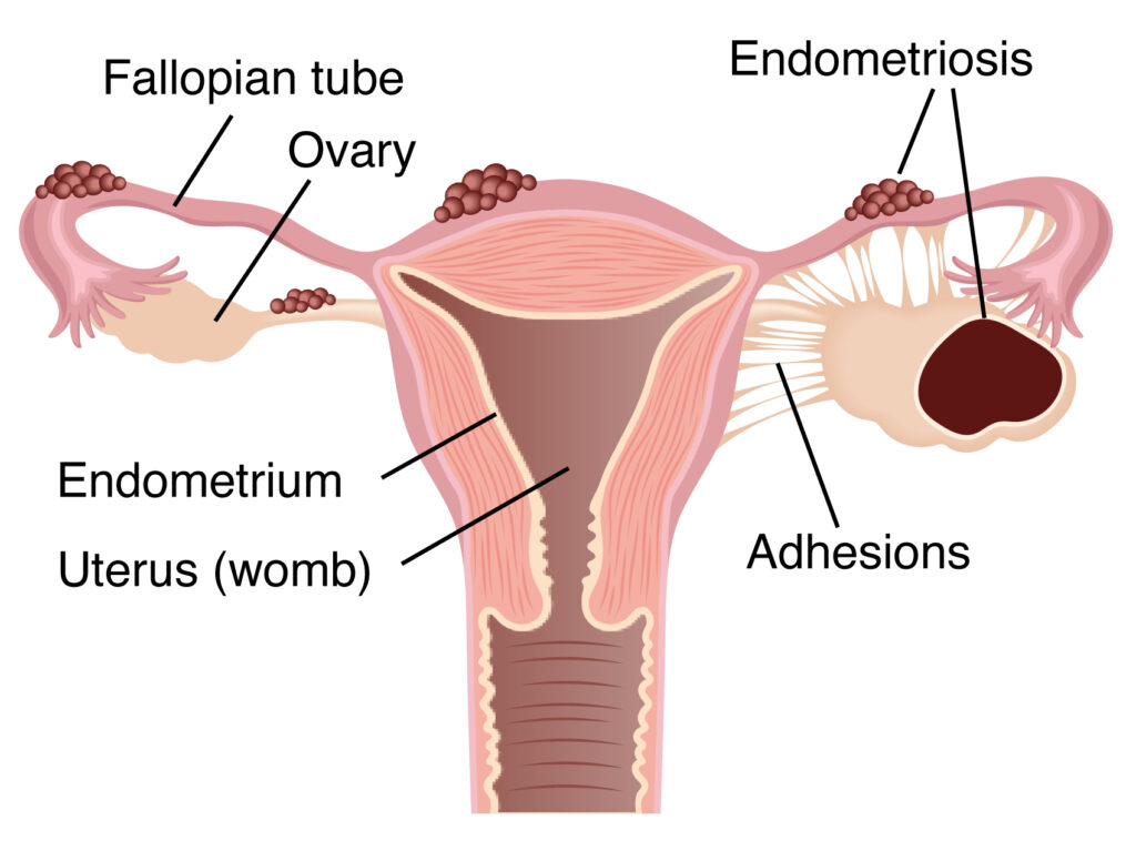 Diagram of uterus with endometriosis on Fallopian tubes and an endometrioma in the right ovary. Adhesions connect the right ovary to the uterus.